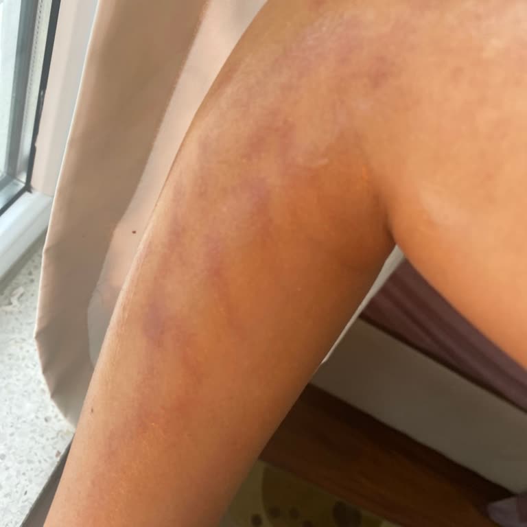 My Women's Güzellik Merkezi (Afyon) Kollarımı Yaktı!