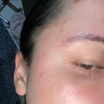 Sinoz Yüz Yıkama Jeli İle Cilt Sorunları Yaşadım