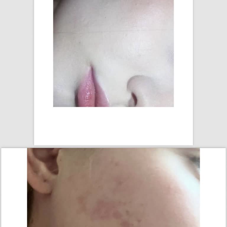 Derma Queen Güzellik & Estetik Cildimi Mahvetti Ve Bana Dava Açtı