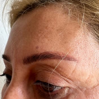 Ema Aydın Kaş İle Mi Sonrası Kırmızı Lekeler