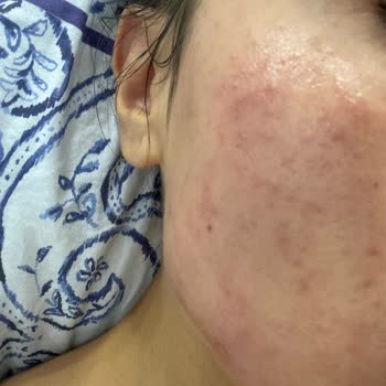 SHE Vec Ürünleri Yüzümde Ciddi Sorunlara Yol Açtı