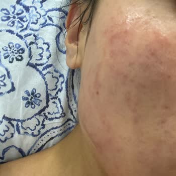 SHE Vec Ürünleri Yüzümde Ciddi Sorunlara Yol Açtı