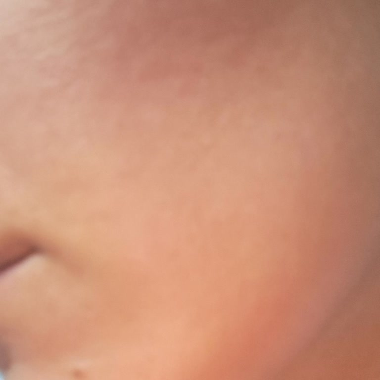 Eyüp Sabri Tuncer Gül Suyu Kullanımı Sonrası Yüzde Anormal Yanma Ve Kızarıklık