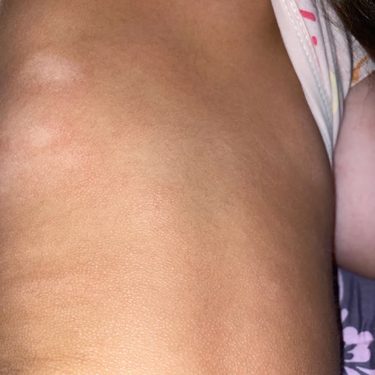 My Daughter Developed Rash and Eczema After Using Mustela Products