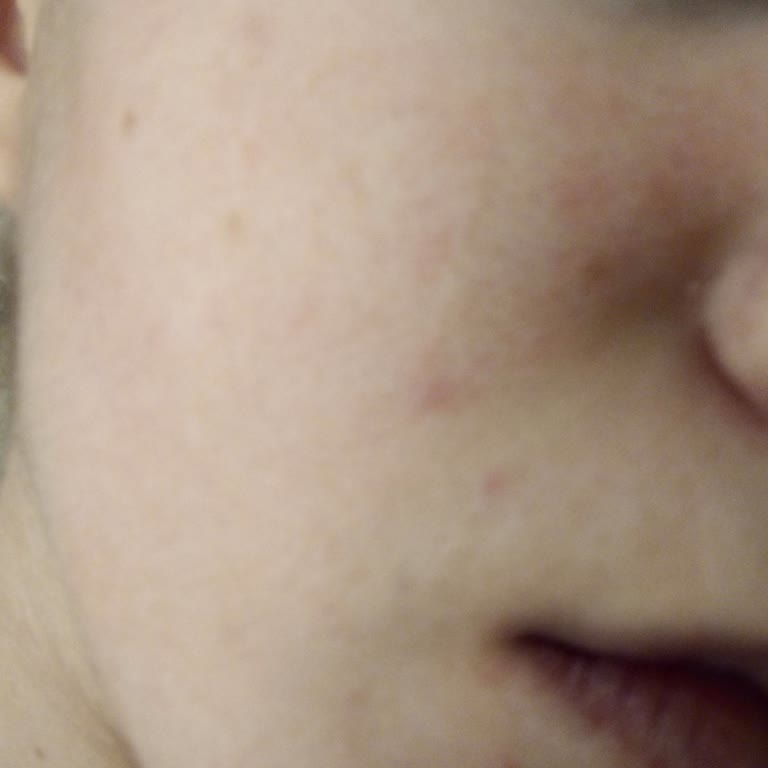 Bioderma Spot Güneş Kremi Cildimi Mahvetti