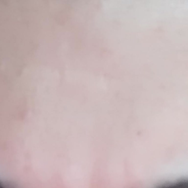 The Purest Solutions The Purest Solition Sivilce Doldu Cildim