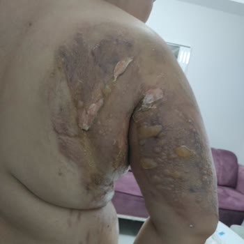 Stanley Termosun Güvenlik Sorunu: Sıcak Su Kazası!