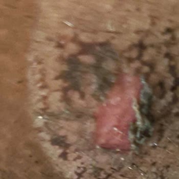 Simetri Estetikte Lazer Sonrası Yanık İzi