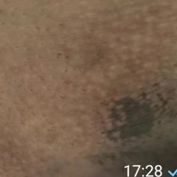 Simetri Estetikte Lazer Sonrası Yanık İzi