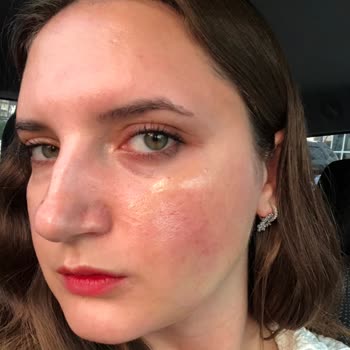 Heaven Deluxe (Uşak) Cilt Bakımında Yaşadığım Olumsuz Deneyim Ve Yanık Sorunu