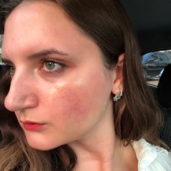 Heaven Deluxe (Uşak) Cilt Bakımında Yaşadığım Olumsuz Deneyim Ve Yanık Sorunu