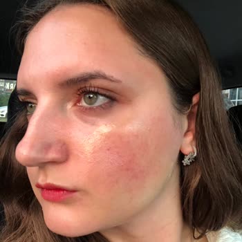 Heaven Deluxe (Uşak) Cilt Bakımında Yaşadığım Olumsuz Deneyim Ve Yanık Sorunu