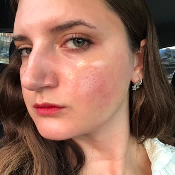 Heaven Deluxe (Uşak) Cilt Bakımında Yaşadığım Olumsuz Deneyim Ve Yanık Sorunu