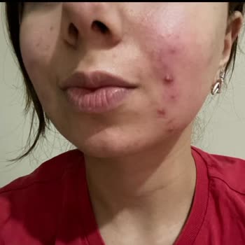 İstanbul Clinic Lazer Tedavisi Sonrası Yaşadığım Sorunlar Ve İptal Süreci