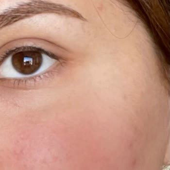 İstanbul Clinic Lazer Tedavisi Sonrası Yaşadığım Sorunlar Ve İptal Süreci