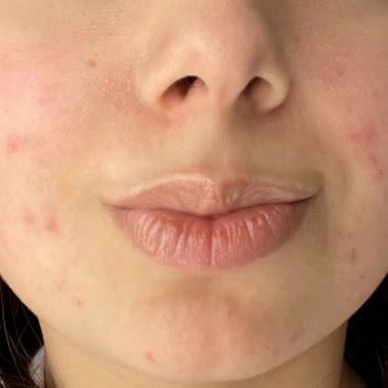 İstanbul Clinic Lazer Tedavisi Sonrası Yaşadığım Sorunlar Ve İptal Süreci