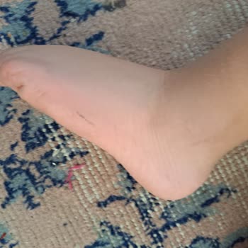 Vicco Çocuğumun Ayağını Yaralayan Sandalet