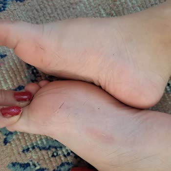 Vicco Çocuğumun Ayağını Yaralayan Sandalet