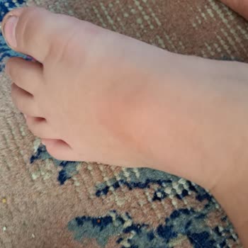 Vicco Çocuğumun Ayağını Yaralayan Sandalet