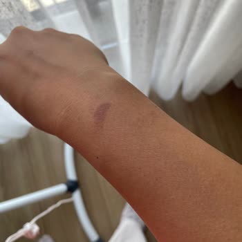 Rose Life Güzellik Merkezi Lazer Epilasyonda Oluşan Yanık