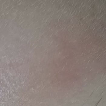 Sinoz Sivilce Ve Kızarıklık