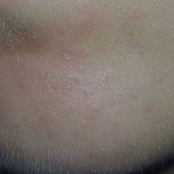 Sinoz Sivilce Ve Kızarıklık