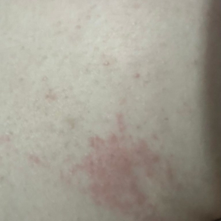 Aris Güzellik Merkezleri Lazer Sonrası Acı