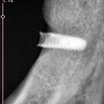 Osstem Implant Osstem İmplant Hakkında