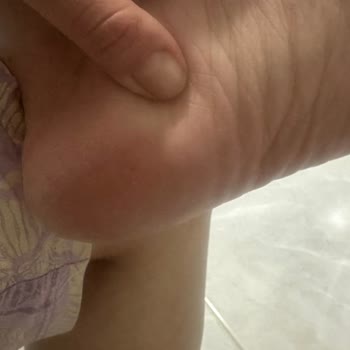 Sağlık Bakanlığı Derimden Kıl Çıkıyor Böcek Çıkıyor