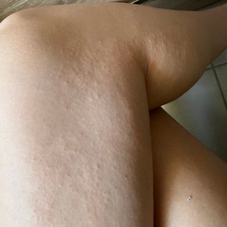 Severe Allergic Reaction to Victoria's Secret Coconut Body Oil, Redness and Swelling