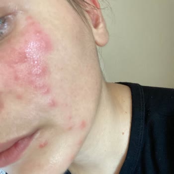 Gratis Bee Beauty Kağıt Maske Cildime Zarar Verdi