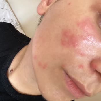 Gratis Bee Beauty Kağıt Maske Cildime Zarar Verdi