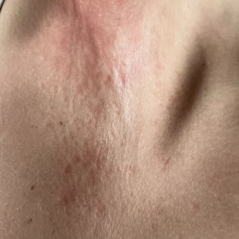 Eda Taşpınar Bronzlaştırıcı Yağ Kaşıntı Ve Kızarıklık Yaptı