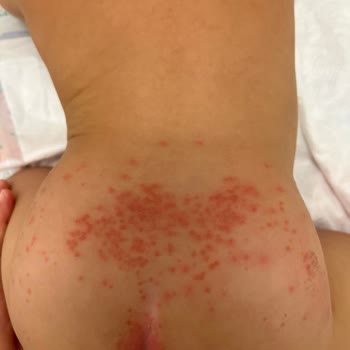 Prima Aktif Bebek Bezi 9 Aylık Bebeğimiz De Pişiğe Sebep Oldu!