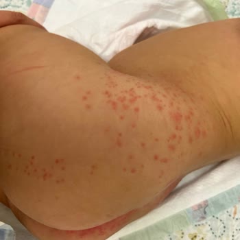 Prima Aktif Bebek Bezi 9 Aylık Bebeğimiz De Pişiğe Sebep Oldu!