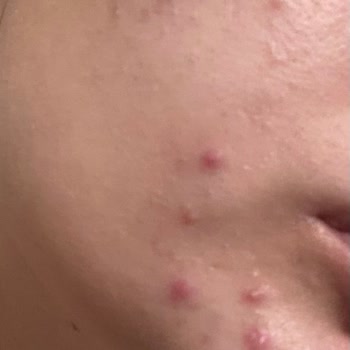 Yves Rocher Akne Karşıtı Ürünler Yüzümde Kistik Akne Yaptı!