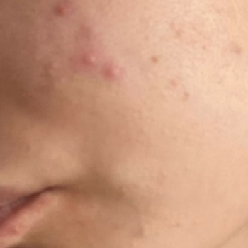 Yves Rocher Akne Karşıtı Ürünler Yüzümde Kistik Akne Yaptı!