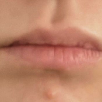 Dent Suadiye Diş Ameliyatı Sonucu Dudaklarda Asimetri Ve Sorumluluk Alınmaması