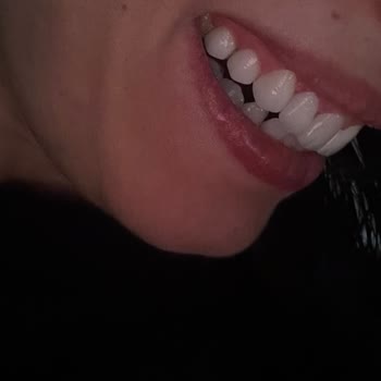 Özel Diyalog Diş Kliniği Hayal Kırıklığı Yaratan Lamine Diş Deneyimi