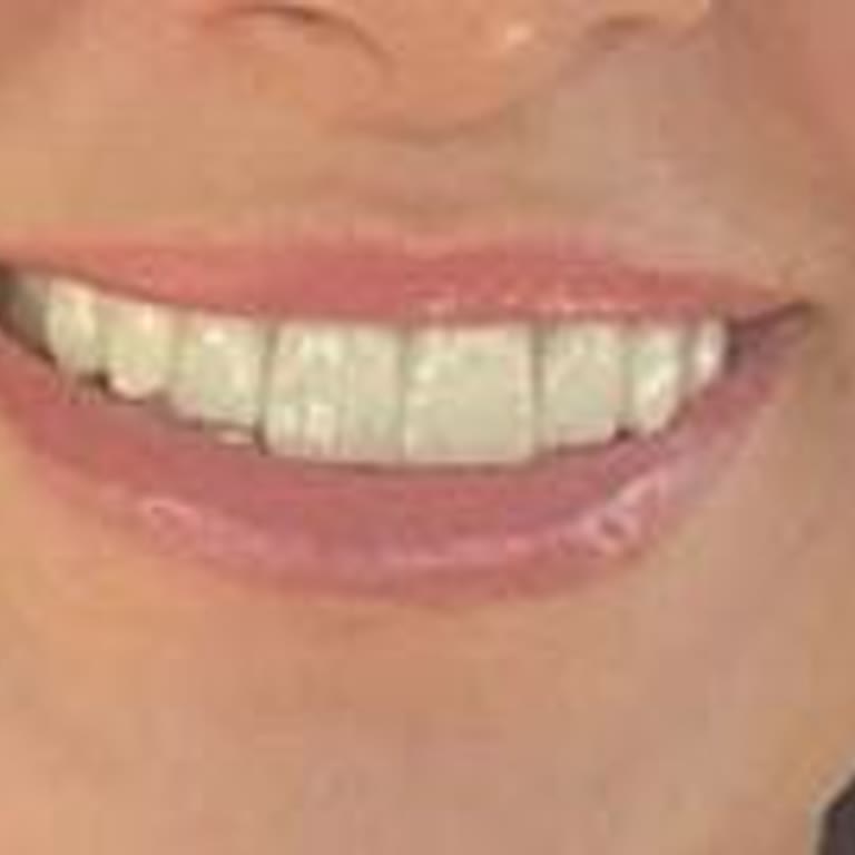 Özel Diyalog Diş Kliniği Hayal Kırıklığı Yaratan Lamine Diş Deneyimi