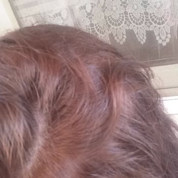 Koleston Saç Boyası Renk Sorunu Ve Cilt Reaksiyonu