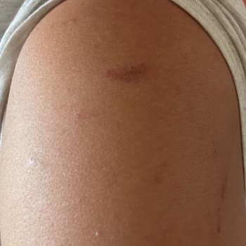 Suit Güzellik Merkezleri Lazer Tedavisinde Yaşanan Yanık Ve Amatör Yaklaşım