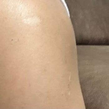 Suit Güzellik Merkezleri Lazer Tedavisinde Yaşanan Yanık Ve Amatör Yaklaşım