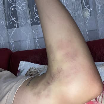 İzmir Bayraklı Hastanesi Yanlış İğne Uygulaması Sonucu Kolum Morardı Hareket Kabiliyetim Azaldı