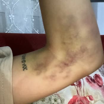 İzmir Bayraklı Hastanesi Yanlış İğne Uygulaması Sonucu Kolum Morardı Hareket Kabiliyetim Azaldı