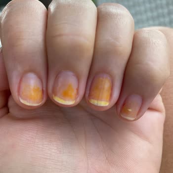 Pastel Kozmetik Pastel Oje Sonrası Tırnaklarda Kalıcı Turunculaşma Ve Zayıflık