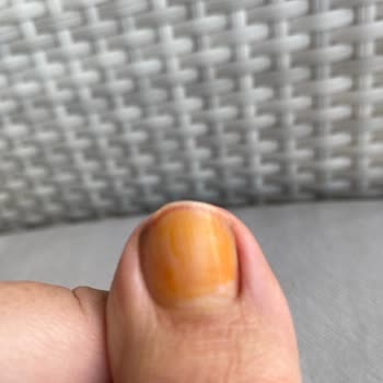 Pastel Kozmetik Pastel Oje Sonrası Tırnaklarda Kalıcı Turunculaşma Ve Zayıflık