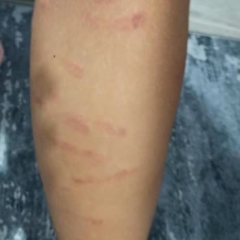 Bozshe Estetik Güzellik Lazer Yanığı Çözüm Yok!