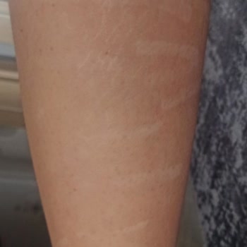 Bozshe Estetik Güzellik Lazer Yanığı Çözüm Yok!