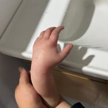 Dr. Nevruz Erez Devlet Hastanesi Iğdır Devlet Hast. Çocuk Acil Doktor İhmali Oğlumun Sağlığına Mal Oldu